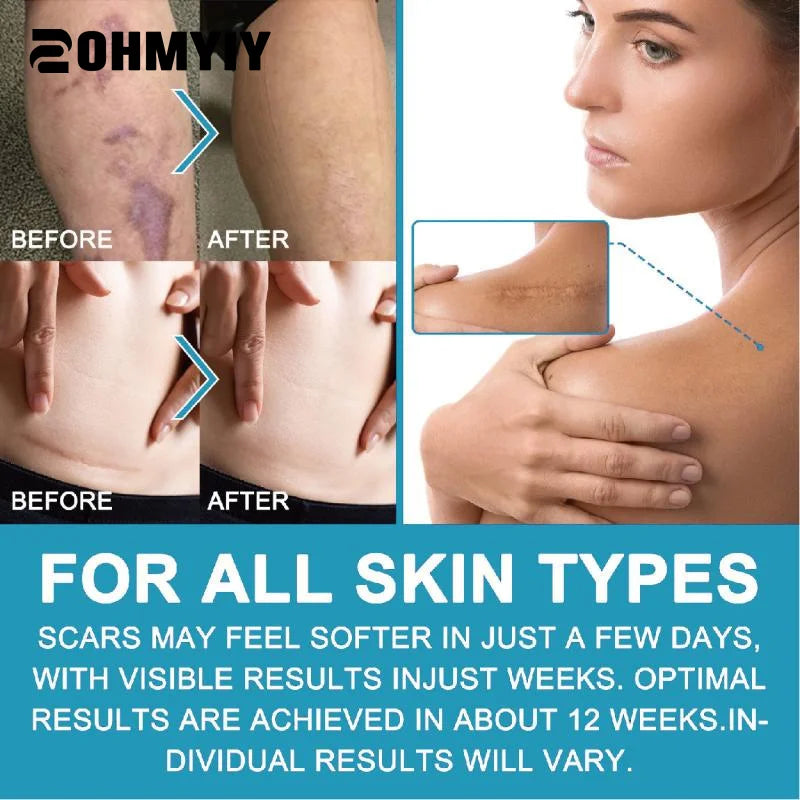 1.5M/1Roll White Silicone Scar Removal Tape For Surgical Scars Medical Grade Scar Sheet Painless Scar Repair Tape Effective